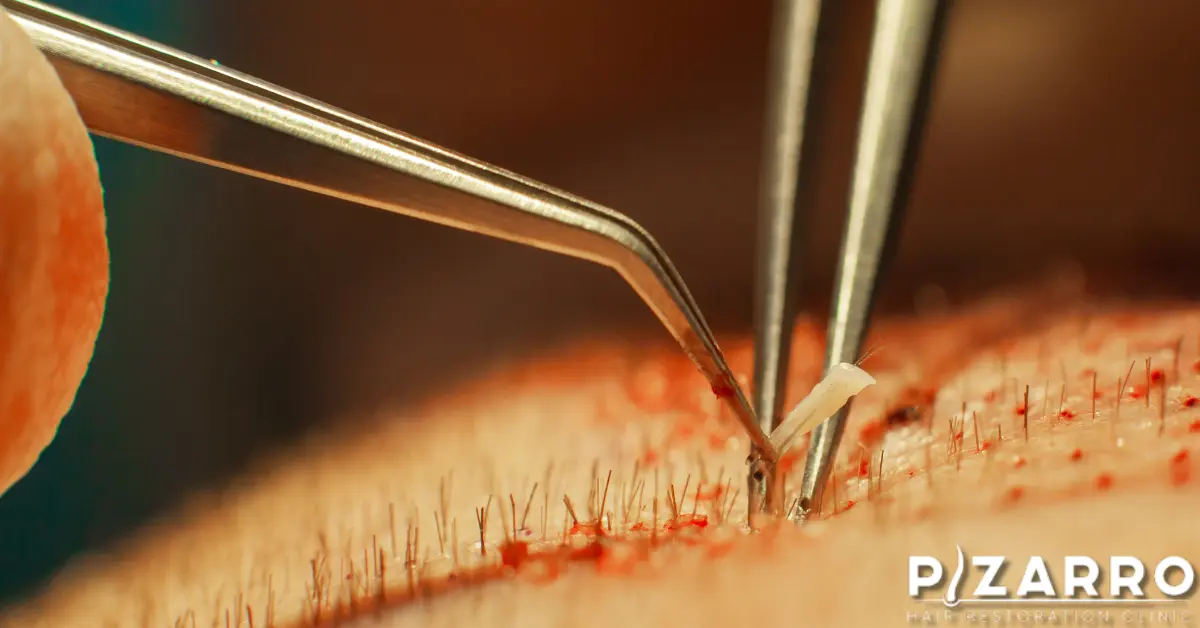 Macrophotography of a hair bulb transplanted into a hairless area. | PHR