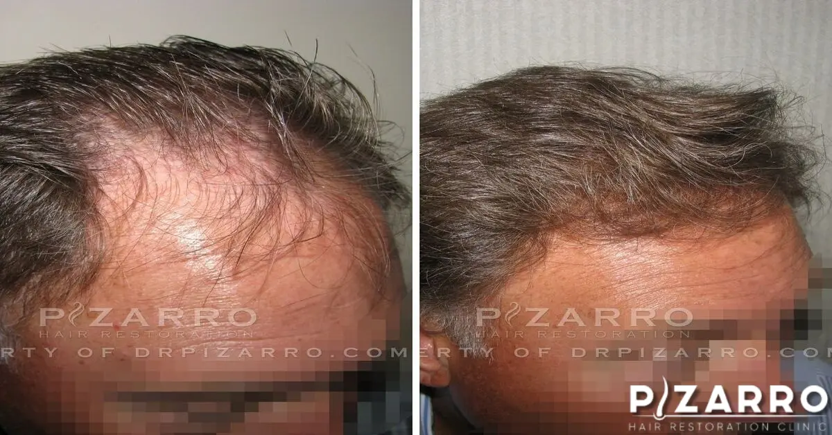 before and After of Hair Restoration from Pizarro Hair Restoration Clinic | PHR