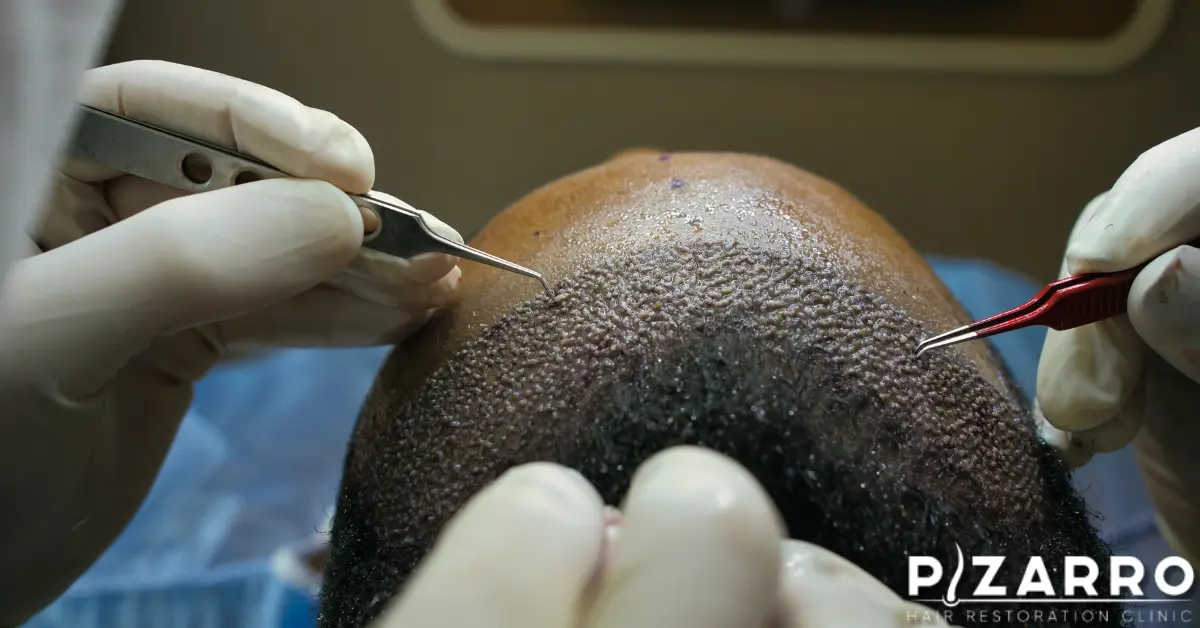 Surgical hair restoration procedure on a patient. | PHR