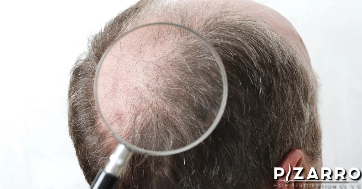Magnified view of hair thinning on scalp. | PHR