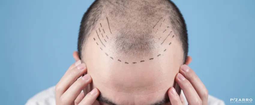Balding man with hair transplant surgery marks on the head