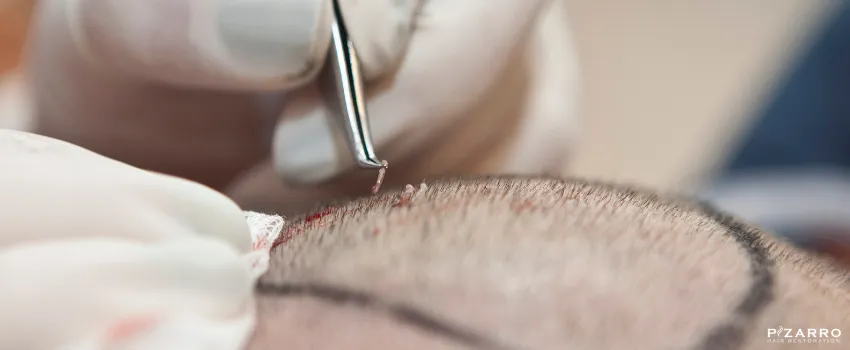 PHR - Close-up shot of a hair transplant procedure